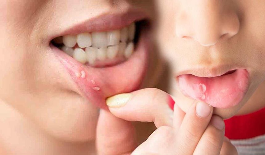 Ağızdaki yara nasıl geçer: Doğal çözümler neler?